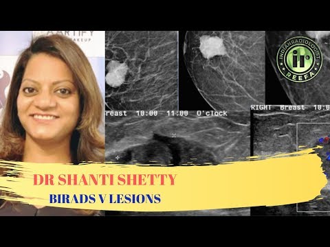 TMT: BIRADS V Lesions by Dr Shanti Shetty