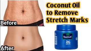 Remove Stretch Marks Fast and Easily from all body parts | How to remove stretch marks at home
