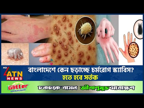 বাংলাদেশে কেন ছড়াচ্ছে চর্মরোগ স্ক্যাবিস? হতে হবে সর্তক | Scabis Spreading in Bangladesh | ATN News