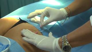 Lifting Glutei Roma: Fili Riassorbibili