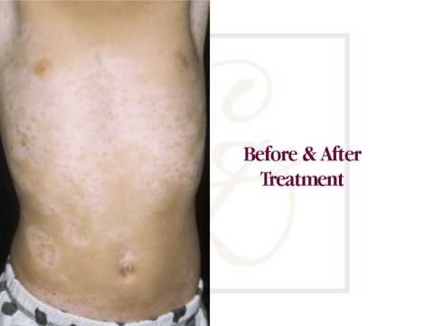 The Michael Jackson Skin Disease | Vitiligo Before & After Treatment