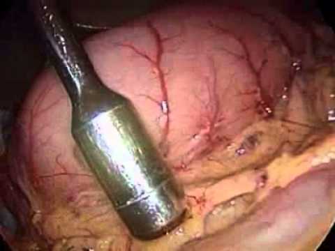 Cancer pancreas liquido abdominal
