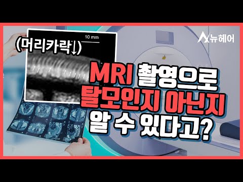 MRI 촬영으로 탈모 진단을 할 수 있다?ㅣ탈모 검사ㅣ뉴헤어