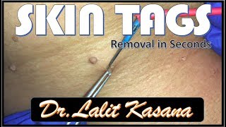 SKIN TAG REMOVAL IN SECONDS  by DR.LALIT KASANA