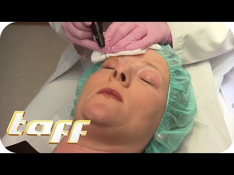 Goodbye to droopy eyelids: Eyelid lift without surgery – What's the use of the new laser treatmen...