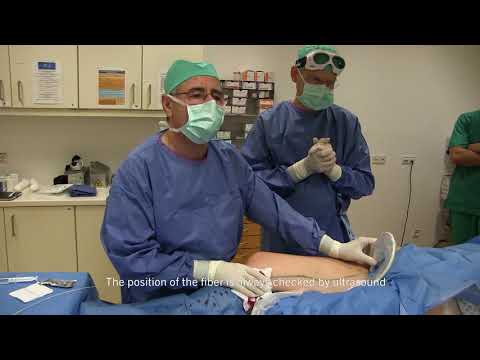 diomax® 1550 | Endovenous laser occlusion (EVLO)