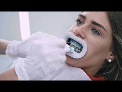 Professionelle Zahnaufhellung - strahlend weiße Zähne in nur einer Sitzung