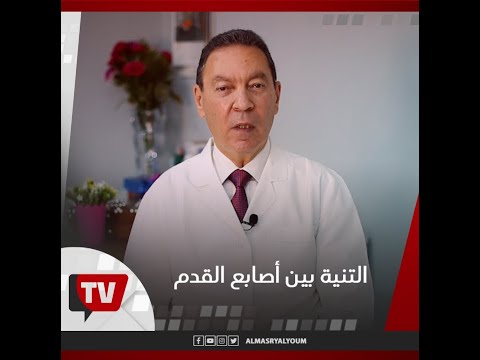 ما حل التنية بين أصابع القدم ؟ تعرف على الإجابة من الدكتور هاني الناظر