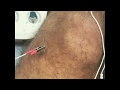 Acupuncture for Relief of Knee Pain