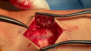 Core Videos (2024): Implantation of (Revi) Posterior Tibial Nerve Stimulator