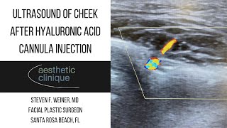 Ultrasound Of Cheek After Hyaluronic Acid Cannula Injection
