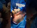 Transgender Breast Augmentation W 775cc Silicon Gummy Bear Implants Plastic Surgery By Dr Seattle
