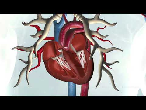 TRANSCATHETER TRANSFEMORAL AORTIC VALVE IMPLANTATION (TAVI TRANSFEMORAL)