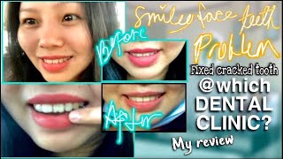 BROKEN TOOTH FIXED At Which DENTAL CLINIC? My REVIEW