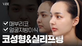[성형 Vlog] 태국에서 한국까지 온 이유! 매부리코·복코·휜코 교정 + 얼굴지방이식 + 실리프팅 풀패키지로 보여드립니다✨
