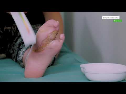 Diabetes fekete láb kezelés