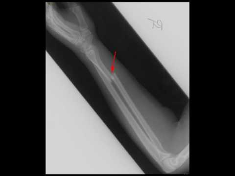 Galeazzi Fracture