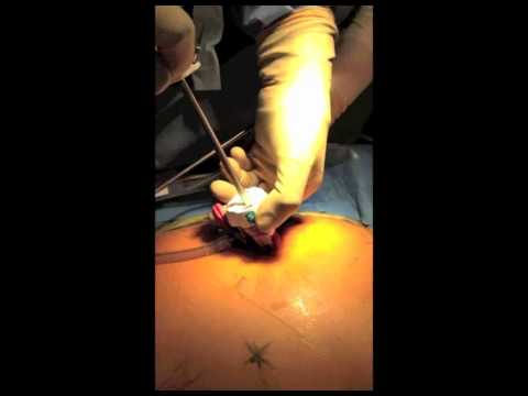 Zabieg wykonania ileostomii dwulufowej metodą laparoskopową z użyciem jednego portu