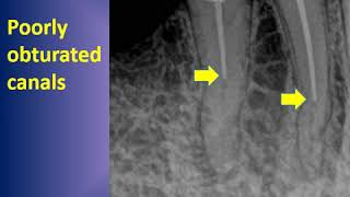 Retreatment of poorly obturated teeth