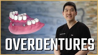 Implant Overdentures Explained with Dr. Roo
