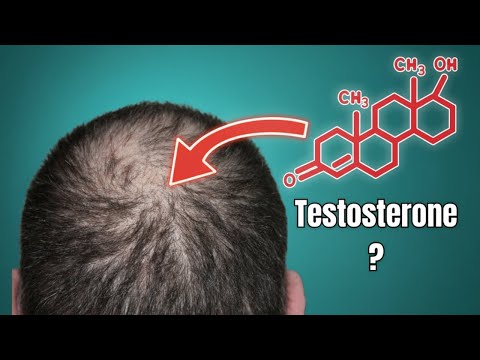 Does High Testosterone Cause Baldness?