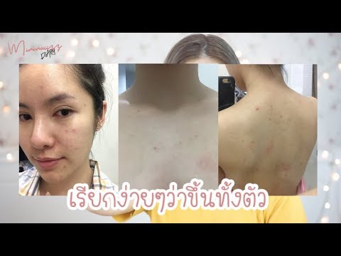 กลากบนหัว เยียวยาพื้นบ้านสำหรับโรคสะเก็ดเงินบนใบหน้า