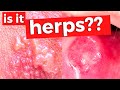 How To Tell If You Have Genital Herpes