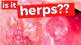 How to tell if you have genital herpes