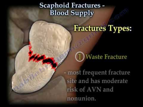 Scaphoid Fractures Blood Supply - Everything You Need To Know - Dr. Nabil Ebraheim