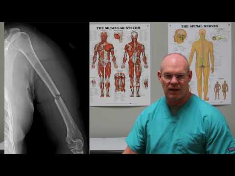 Mid-Shaft Humerus Fracture | Episode 30