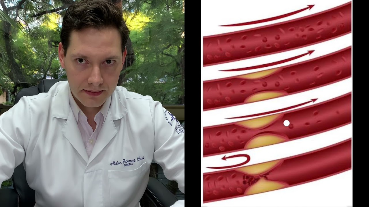 VOCÊ SABE O QUE É O ATEROMA DE AORTA?? É PERIGOSO??