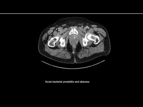 Prostate Hyperplasia
