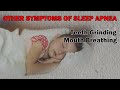 What are the signs of sleep apnea in children?