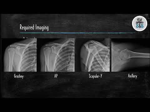 Proximal Humerus Fracture