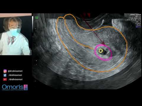 Mom's uterus in early pregnancy - 5 weeks
