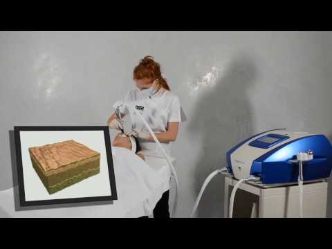 WELL ÉTAGE präsentiert 3D Skin Rejuvenation mit dem Mesotherm by Biotec Italia
