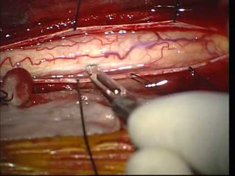 Totalresektion eines Ependymoma vom Hals- und Brustrückenmark.