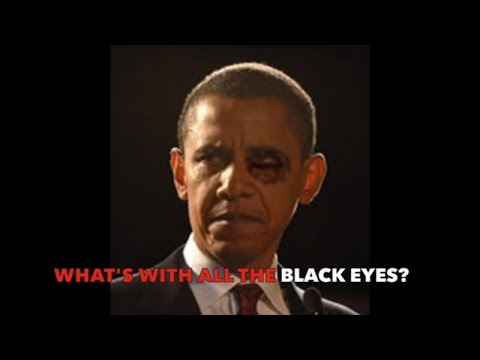 My 2 Cents Presents:  What's With All The Black Eyes?