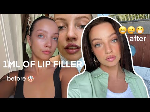 getting lip fillers for the first time - healing process start to finish