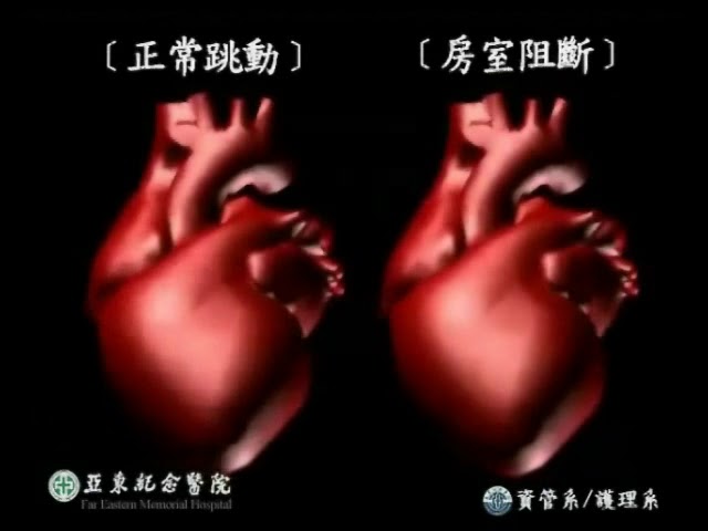 房室阻斷