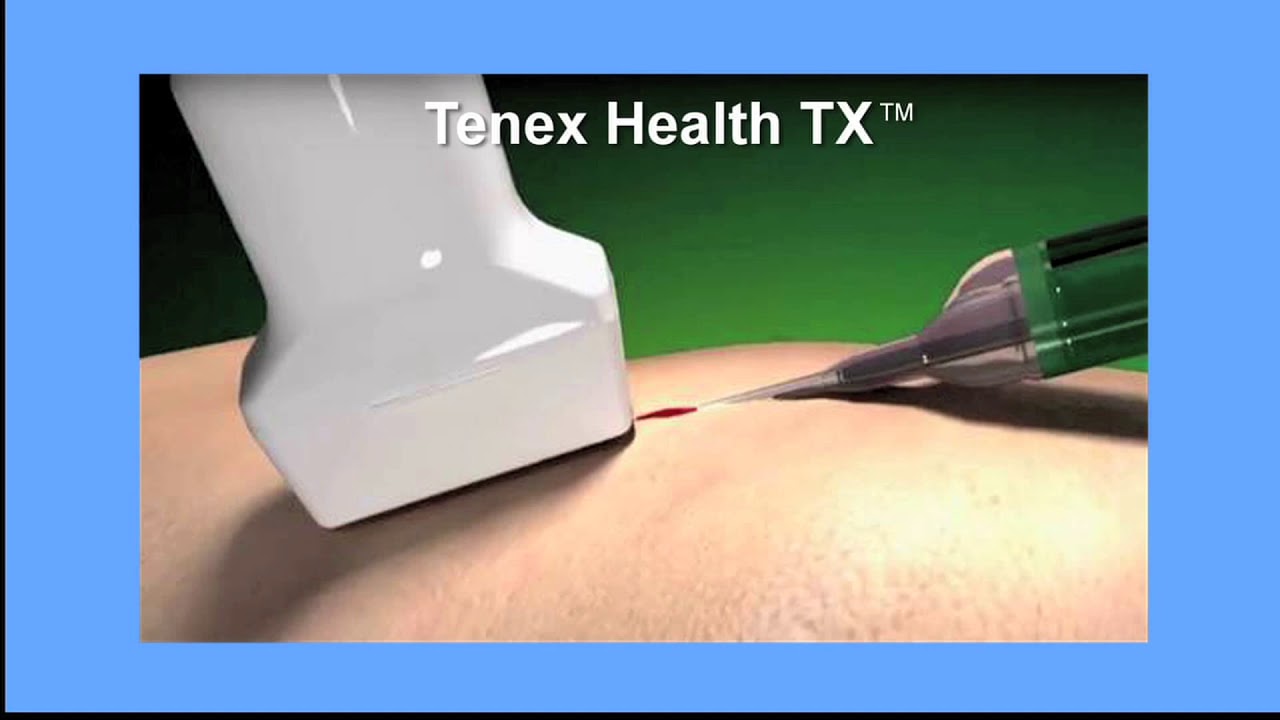 Tenex Health TX treats chronic tendonitis and plantar fasciitis pain