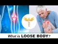 What is a Loose Body? (Knee)
