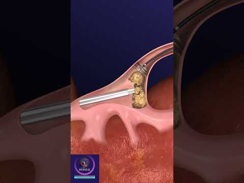 Ureteroscopy Procedure for Removal of Kidney Stones #shorts