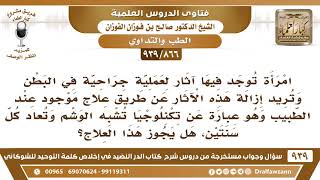 [866 -939] امرأة تريد إزالة آثار عملية جراحية في البطن عن طريق علاج تكنلوجيا تشبه الوشم فما حكم ذلك؟ image