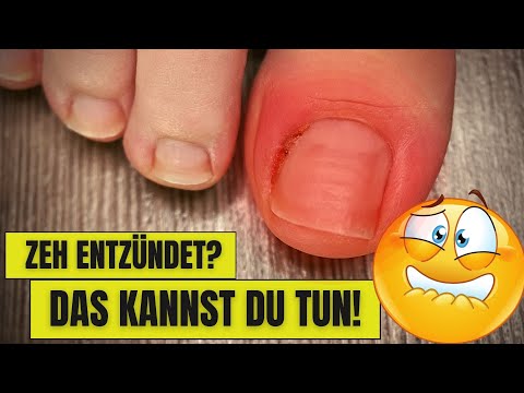 INFLAMED TOE - WHAT YOU CAN DO! | How to treat an INFLAMMED TOE!