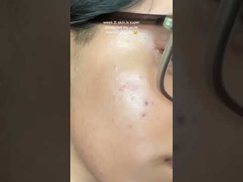 my 1 month tretinoin progress! (with acne prone skin)