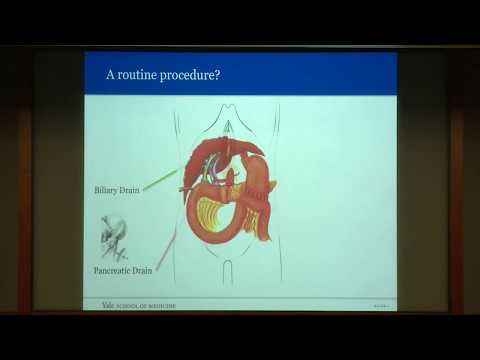 Refining the Whipple Procedure: Yale Contributions