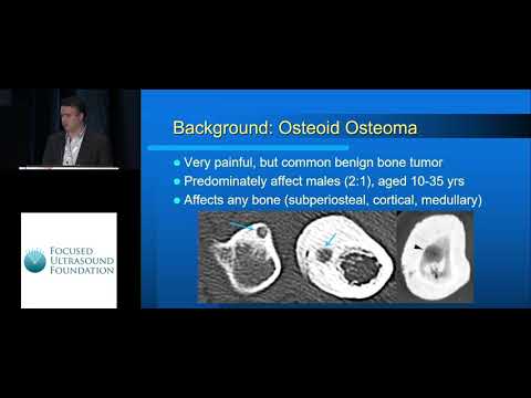 Adam Waspe - FUS Osteoid Osteoma Treatment Registry (2018)