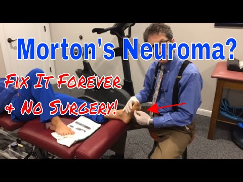 Morton's Neuroma Fix it Forever