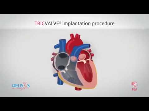 TricValve Implantation Procedure